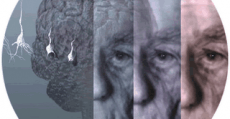 alzheimer sintomas como tratar