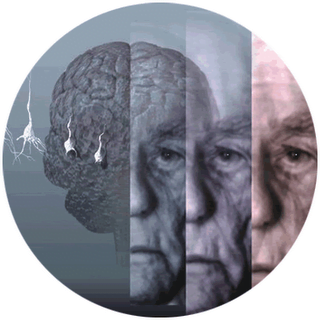 alzheimer sintomas como tratar